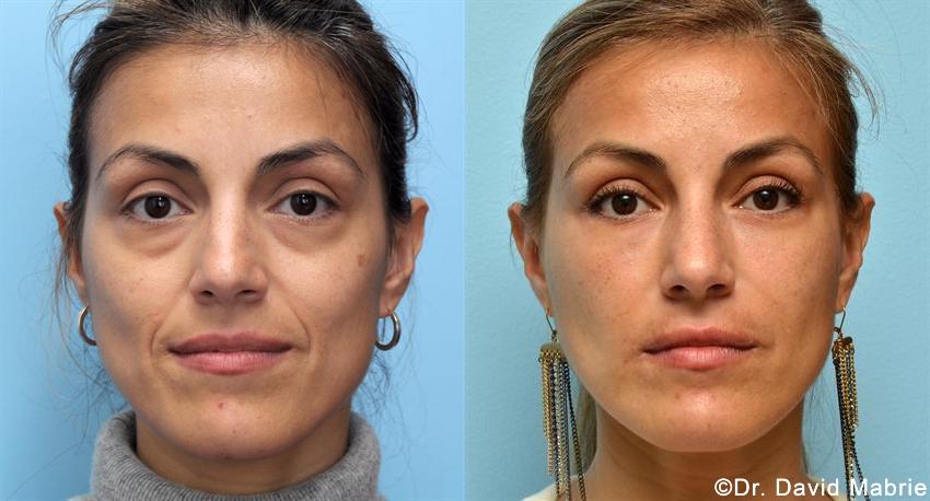 Galderma Fillers - A before and after photo of a woman 's face.