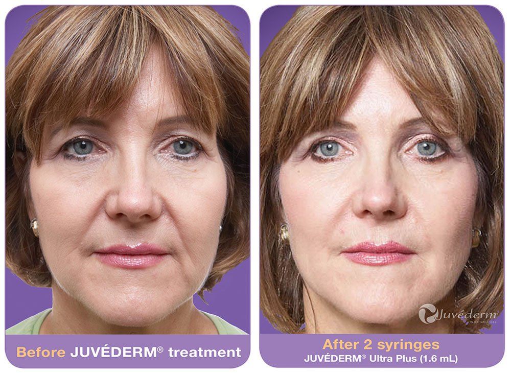 A before and after photo of a woman 's face before and after Juvéderm treatment.
