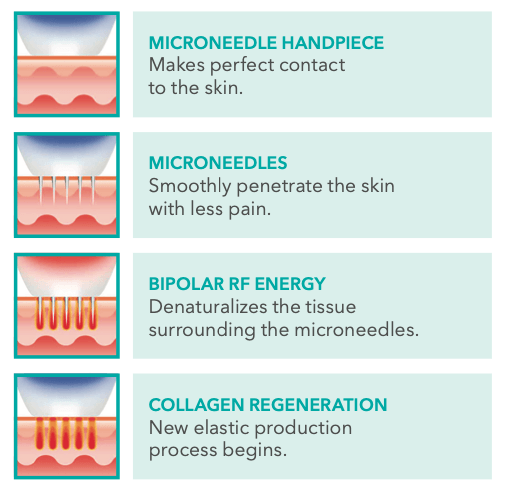 A diagram of microneedle handpiece microneedles bipolar rf energy and collagen regeneration