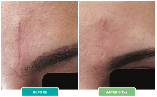 Close up photo of a scar on a person's face before and after using Secret RF