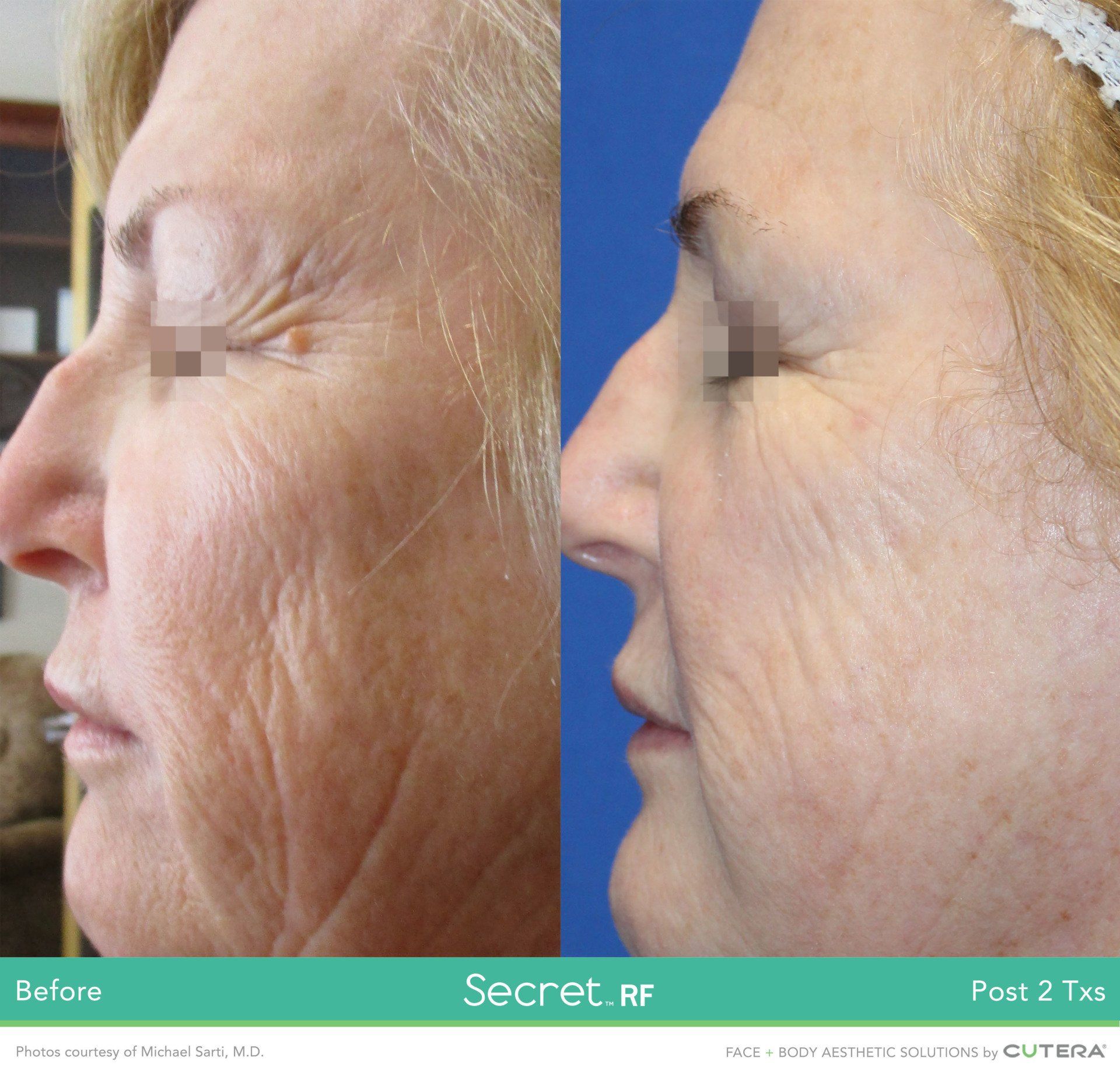 Photo of a woman 's face  before and after using Secret RF