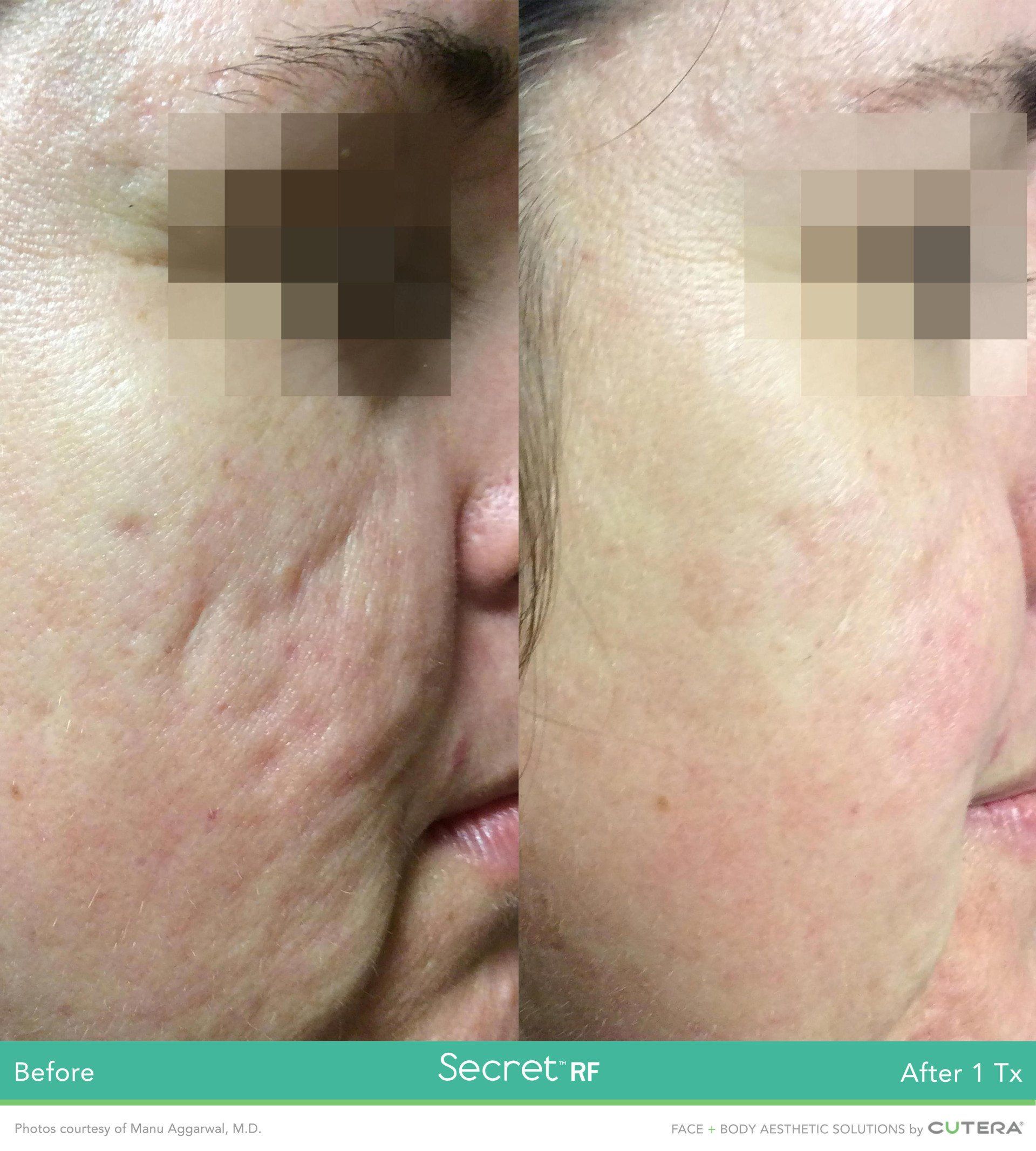 Close up photo of face before and after Secret RF