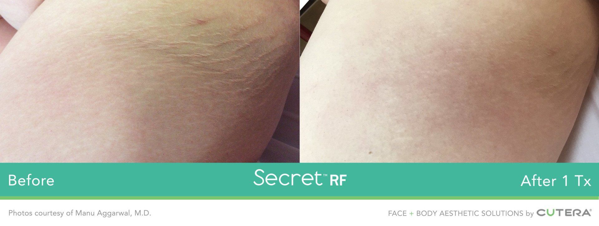 Photo of a person 's leg before and after Secret RF