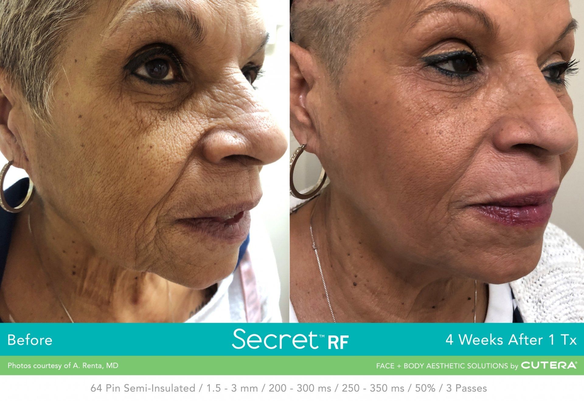Photo of a woman 's face before and after Secret RF