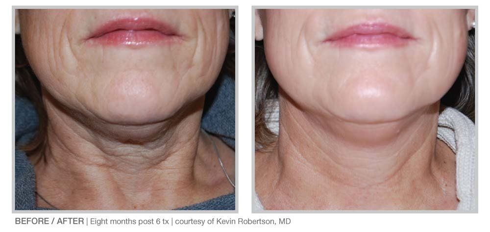 SkinTyte results- A before and after photo of a woman 's neck and face