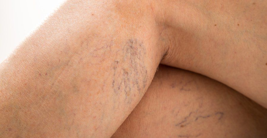 A close up of a person 's leg with varicose veins.