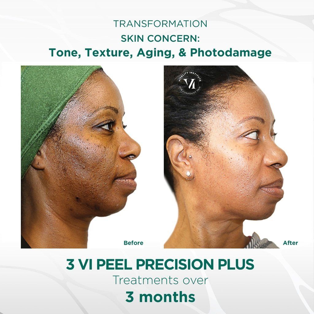 Vi Peel results- A before and after photo of a woman's face with acne scars