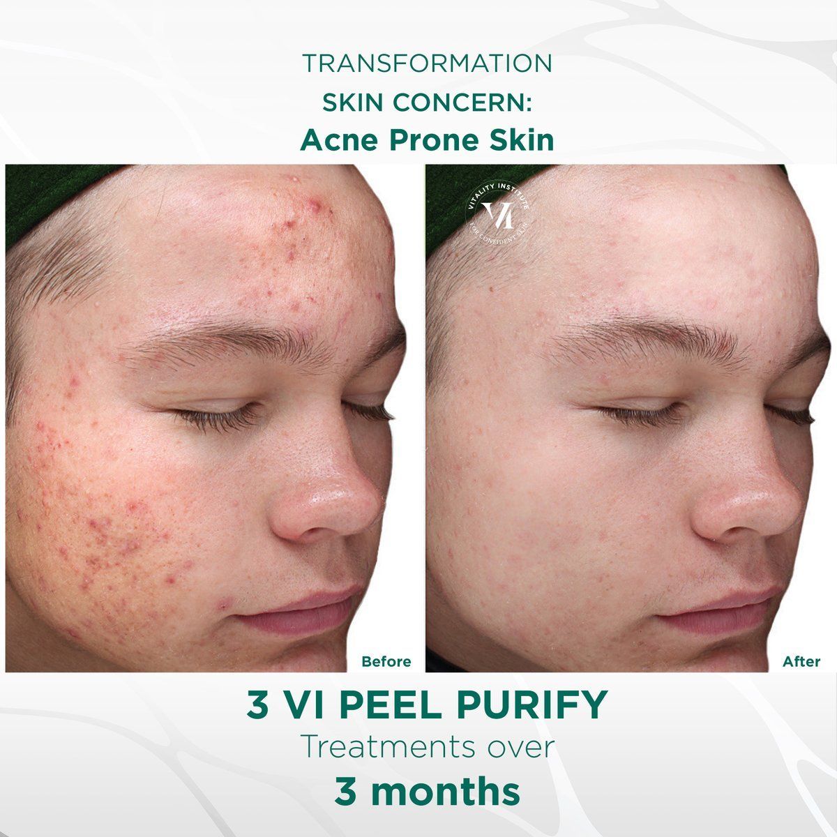 Vi Peel results- A before and after photo of a person 's face with acne prone skin
