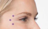 A close up of a woman 's face with three dots showing the injection sites for crows feet