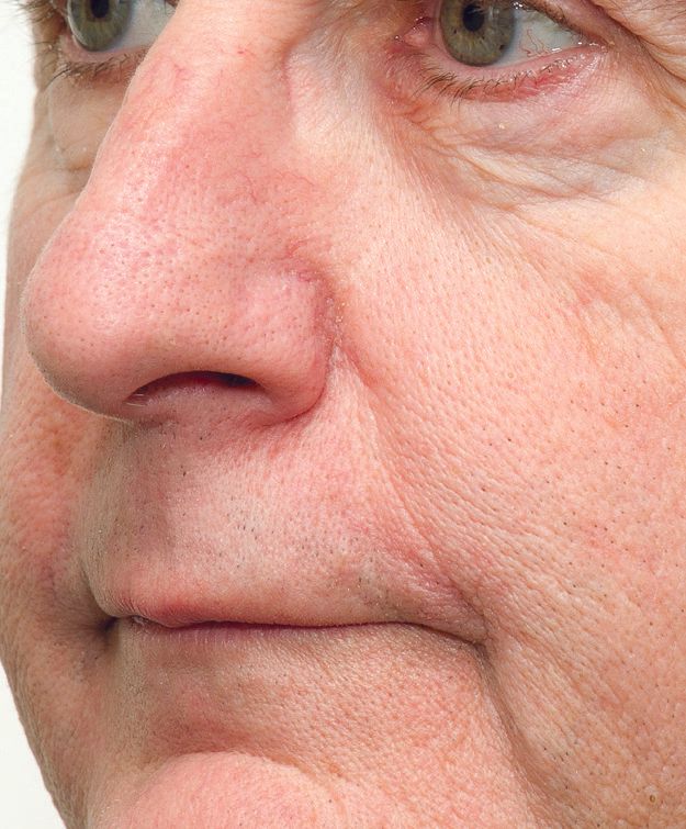 BBL After Photo -  A close up of a man 's face with reduced redness and improved texture