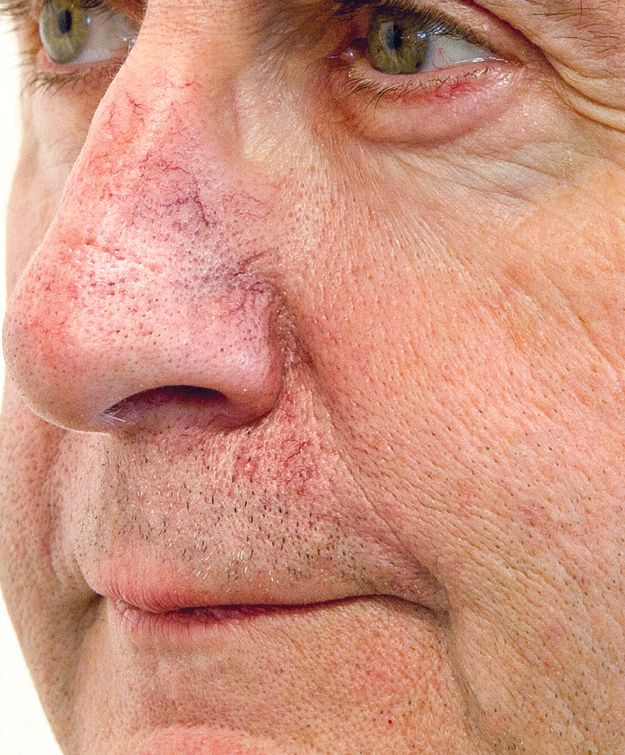 BBL Before Photo - A close up of a man 's face with red spots on his nose.