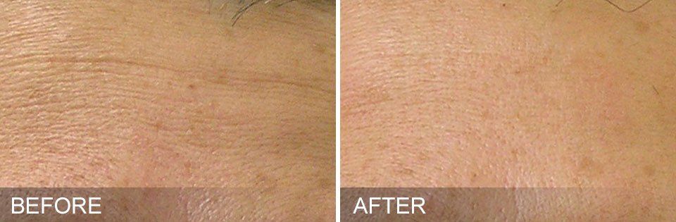 HydraFacial results- A before and after close up photo of a person's forehead.