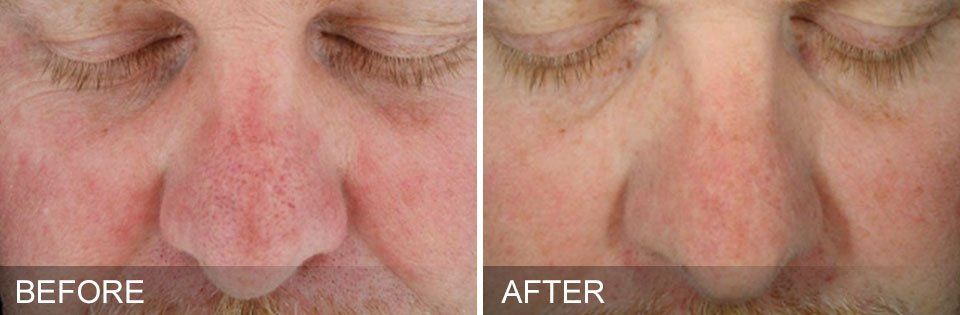 HydraFacial results- A before and after photo of a man's face