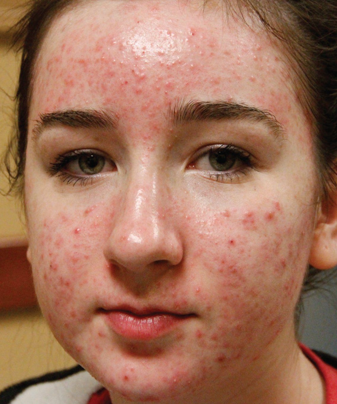 BBL Before Photo - A young woman's face with cystic acne.