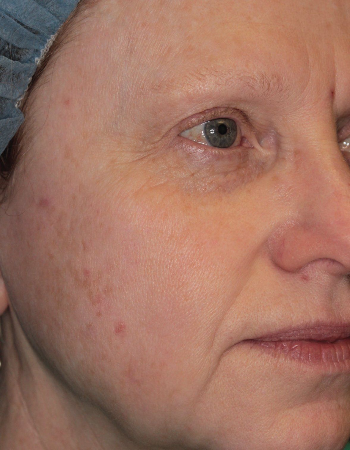 BBL Before Photo - A close up of a woman 's face with much less acne and improved texture