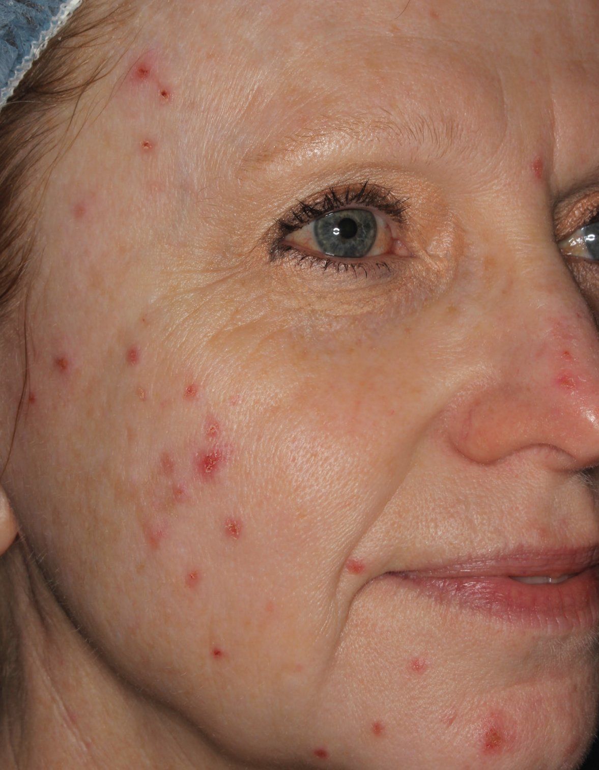 BBL Before Photo - A close up of a woman 's face with acne on it.