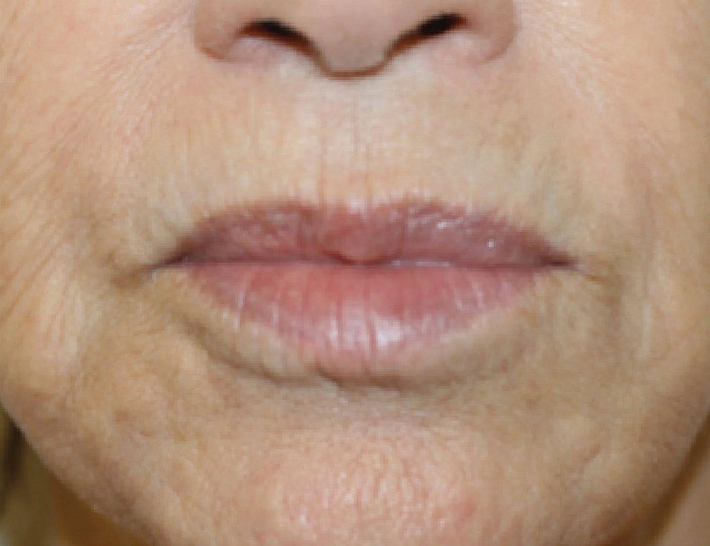 BBL After Photo - A close up of a woman's lips with reduced wrinkles 