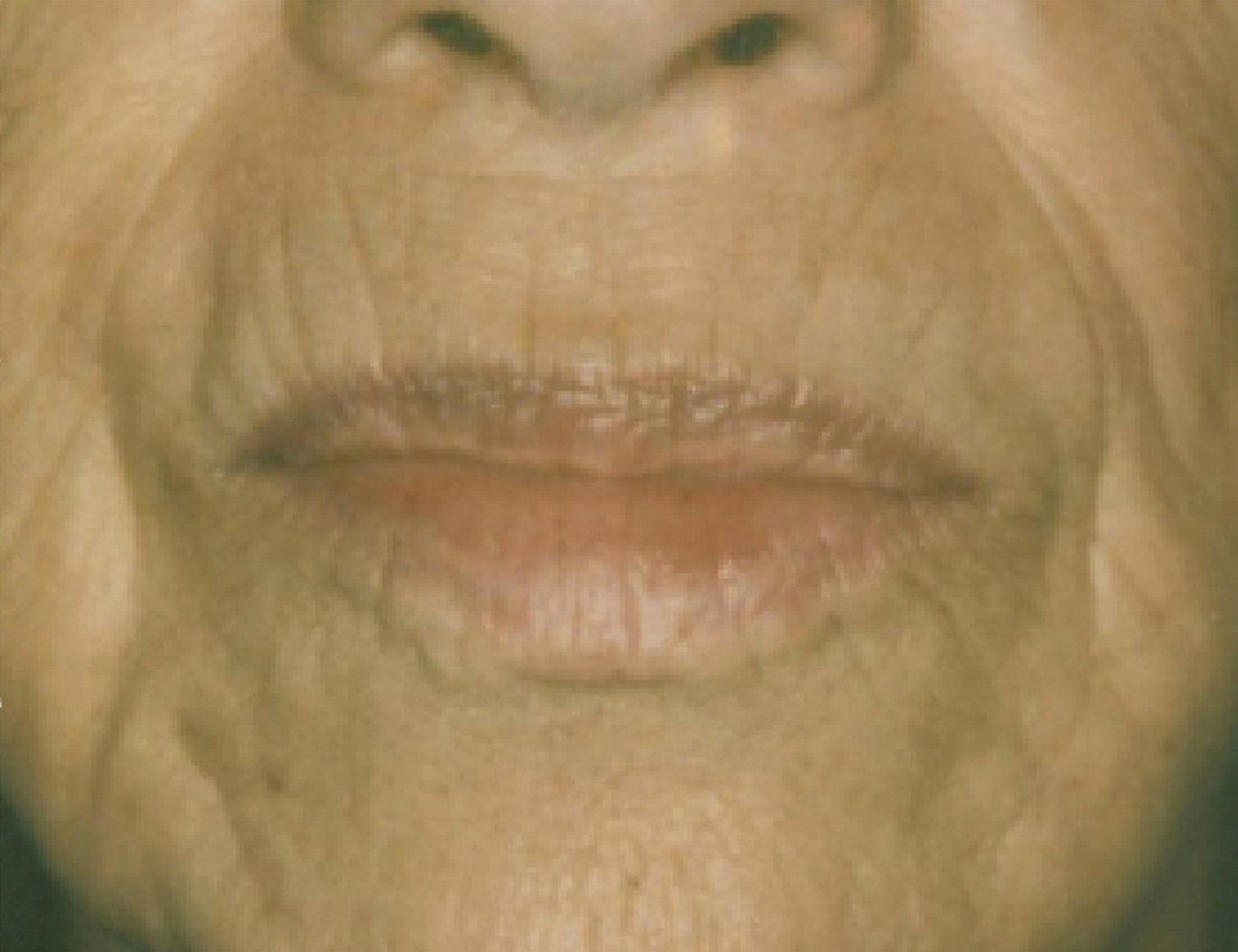 BBL Before Photo - A close up of a woman 's lips.