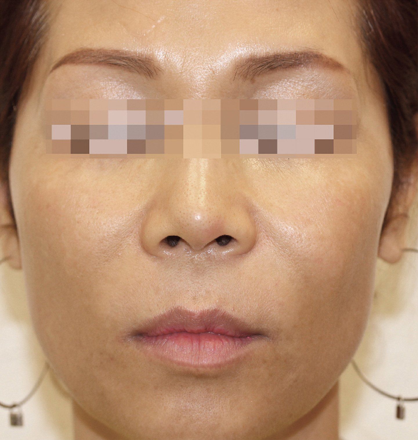BBL After Photo - A close up of a woman's face with improved texture and less wrinkles