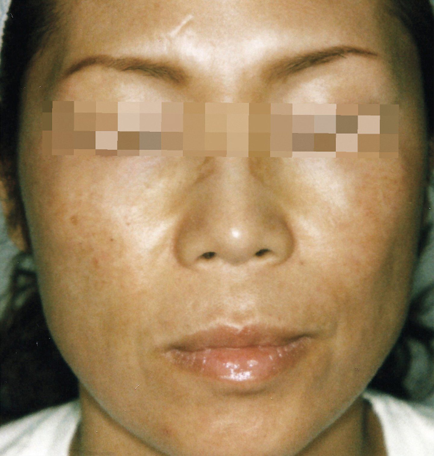 BBL Before Photo - A close up of a woman's face