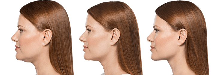 Allergan Fillers- Before and after photo of woman's chin