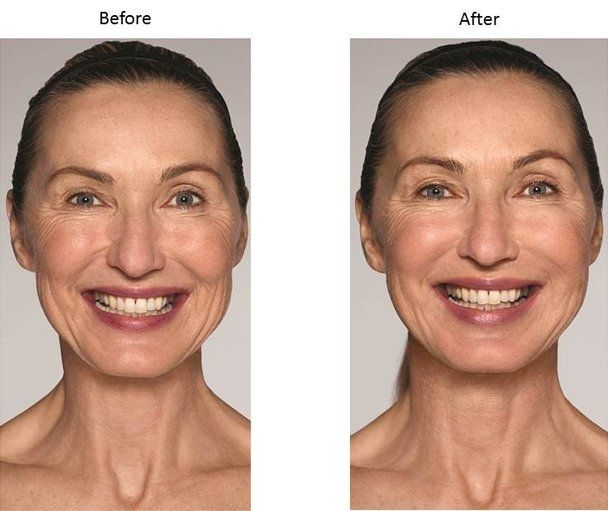 Galderma Fillers - A before and after picture of a woman 's face