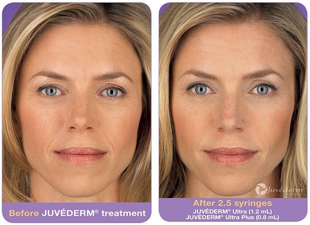 A before and after photo of a woman 's face before and after Juvéderm treatment