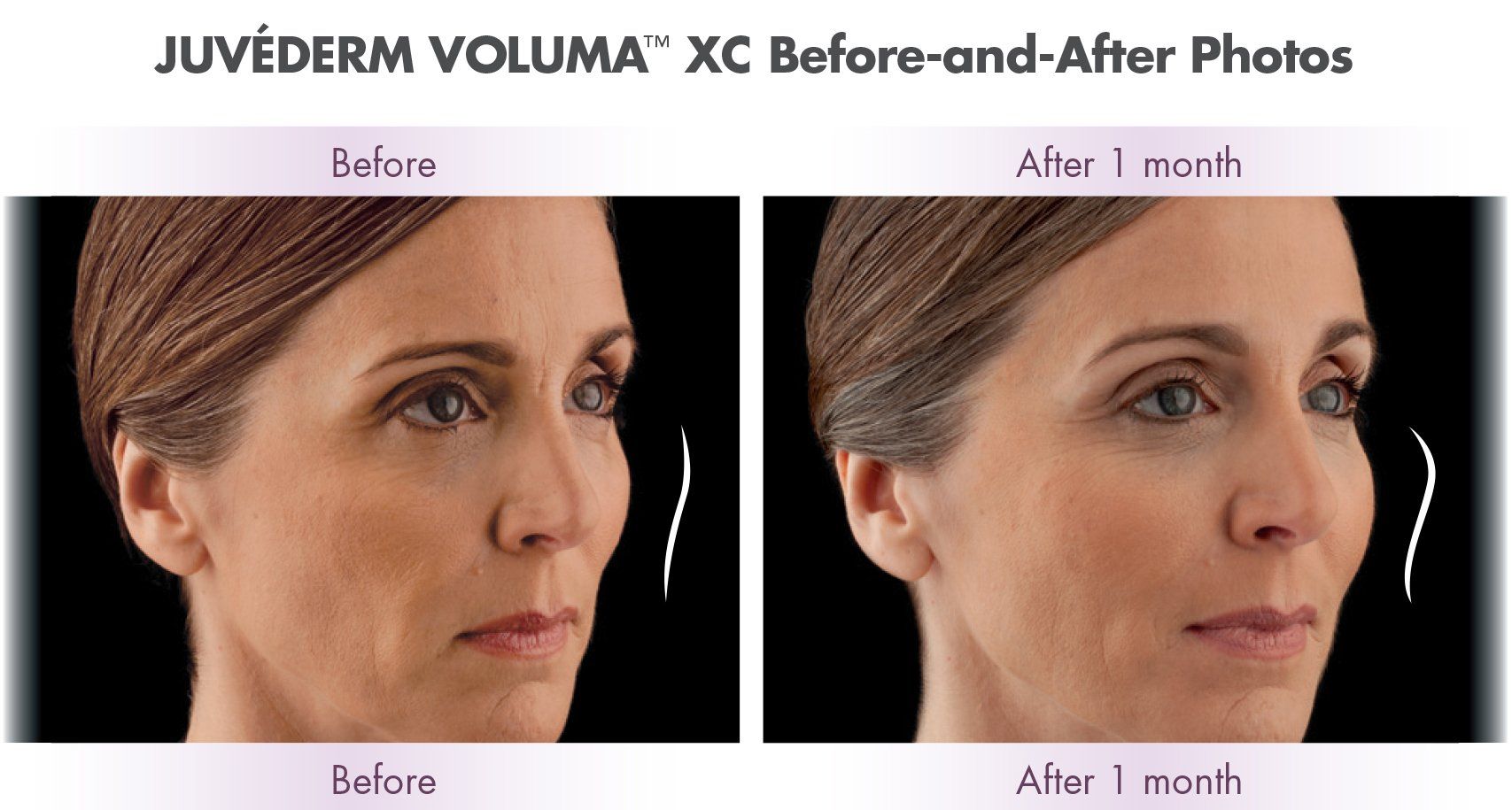 A before and after photo of a woman 's face before and after Juvéderm 