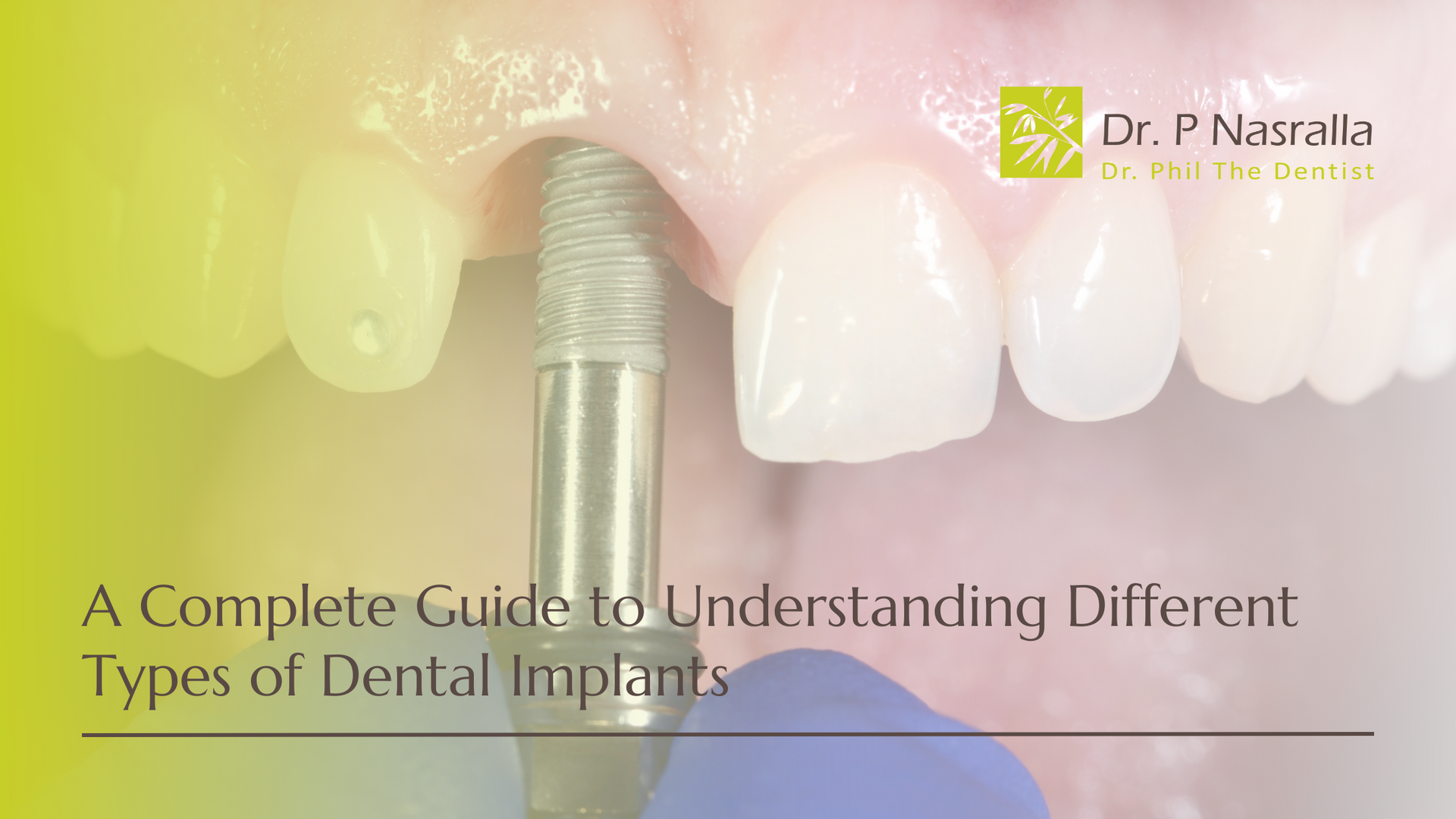 A complete guide to understanding different types of dental implants