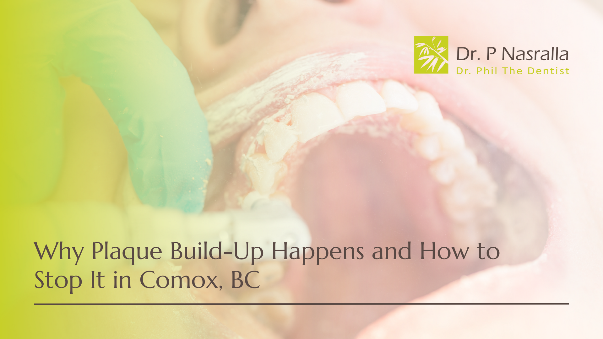 Why plaque build up happens and how to stop it in comox bc