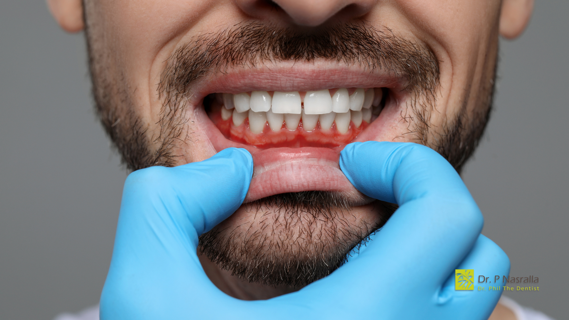 A man with a beard is being examined by a dentist.