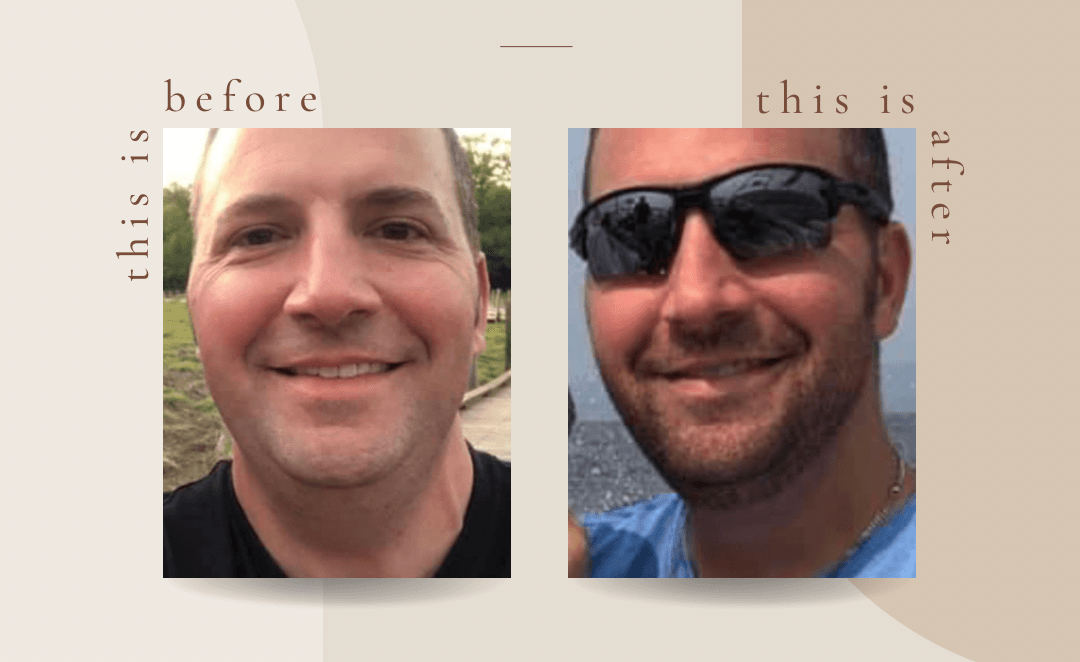 evoke: jowls - before and after