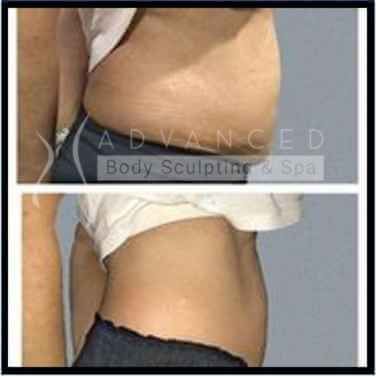 Body sculpting results: before and after