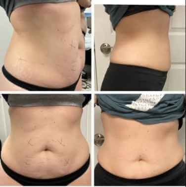 cryo results: abs and flanks