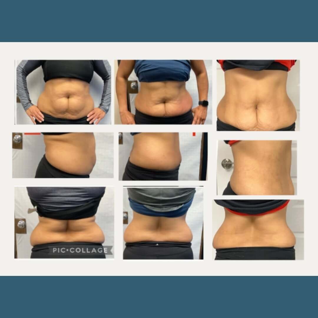 cryo results, before, six months, nine months