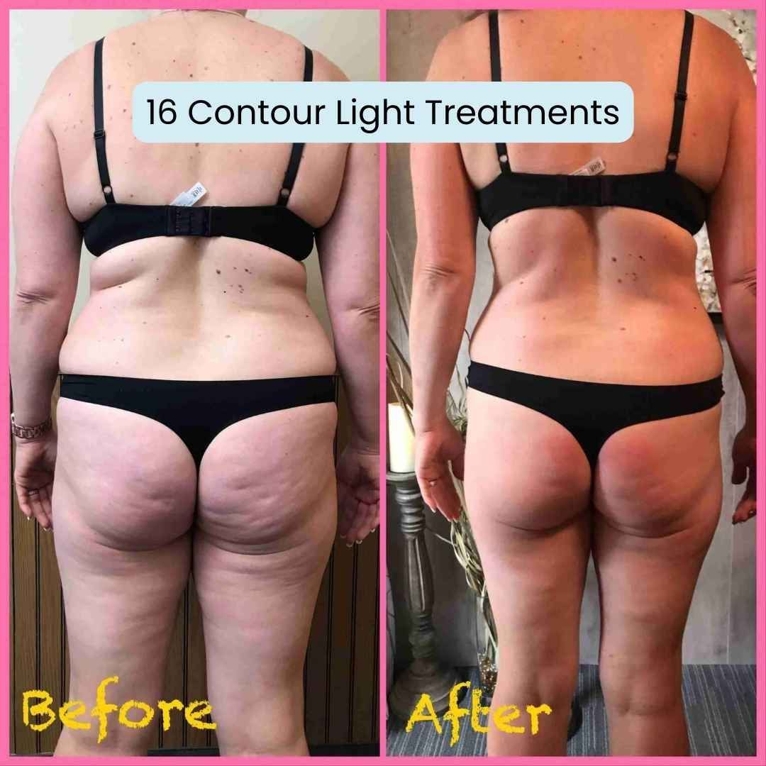 contour light before and after results for body contouring