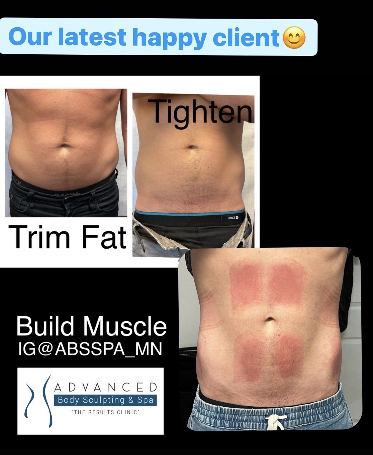 EvolveX: stomach - before and after 2