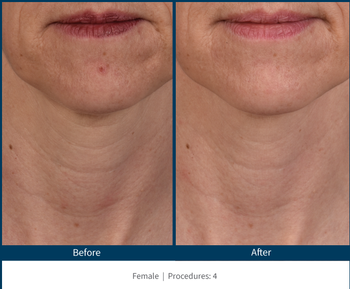A before and after photo of a woman 's face