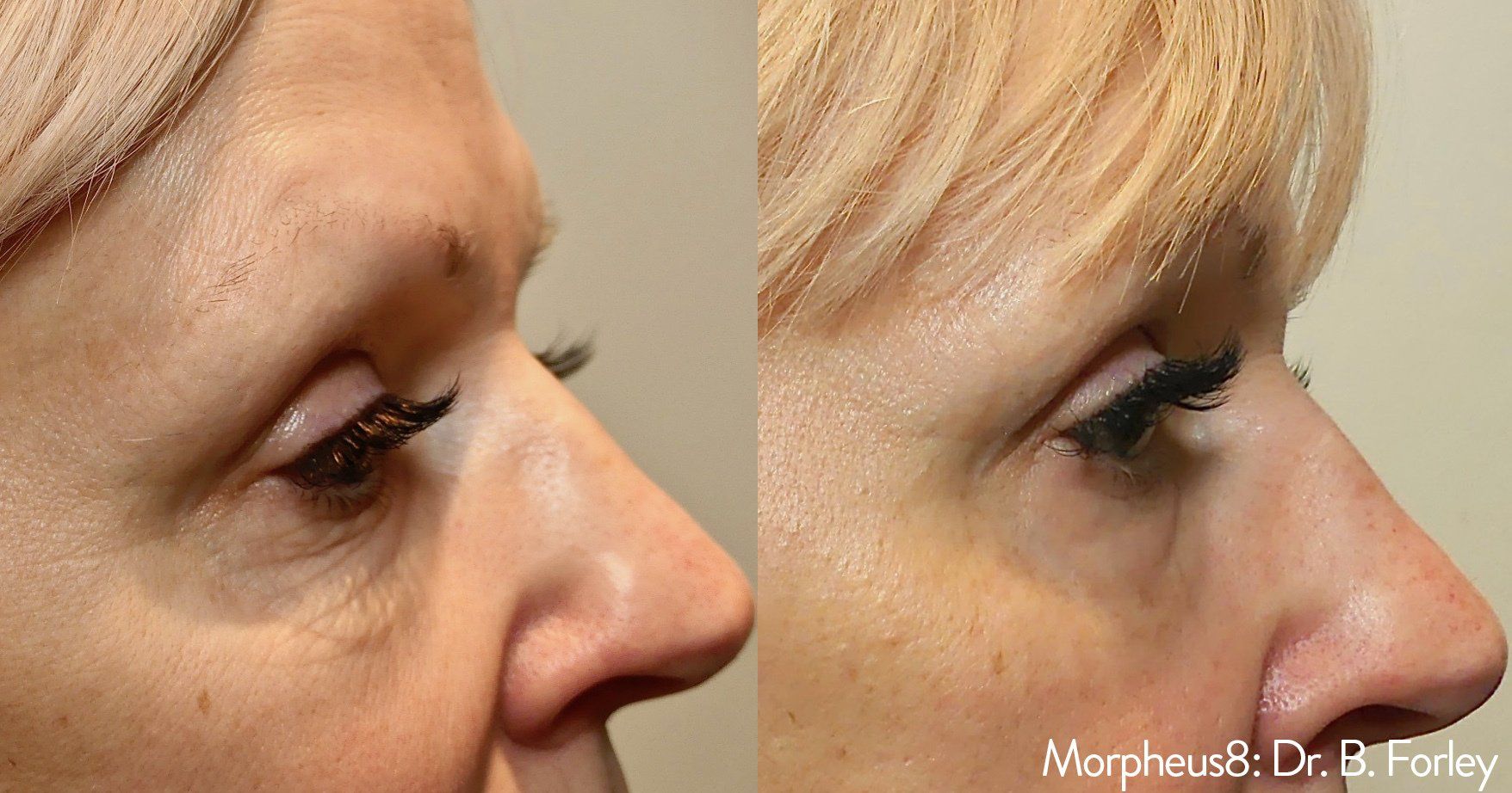 Morpheus8 crows feet: before and after 2