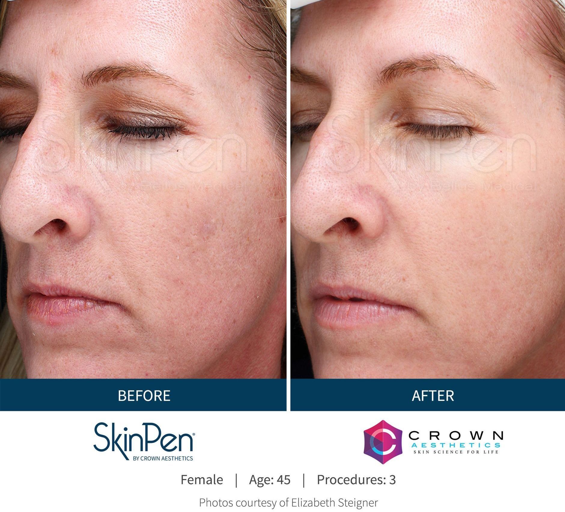 A before and after photo of a woman 's face.