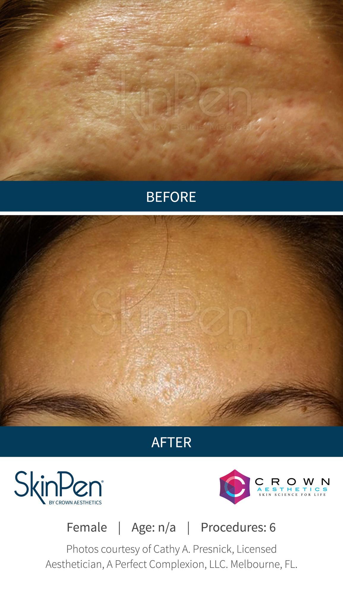A before and after photo of a woman 's forehead with acne.