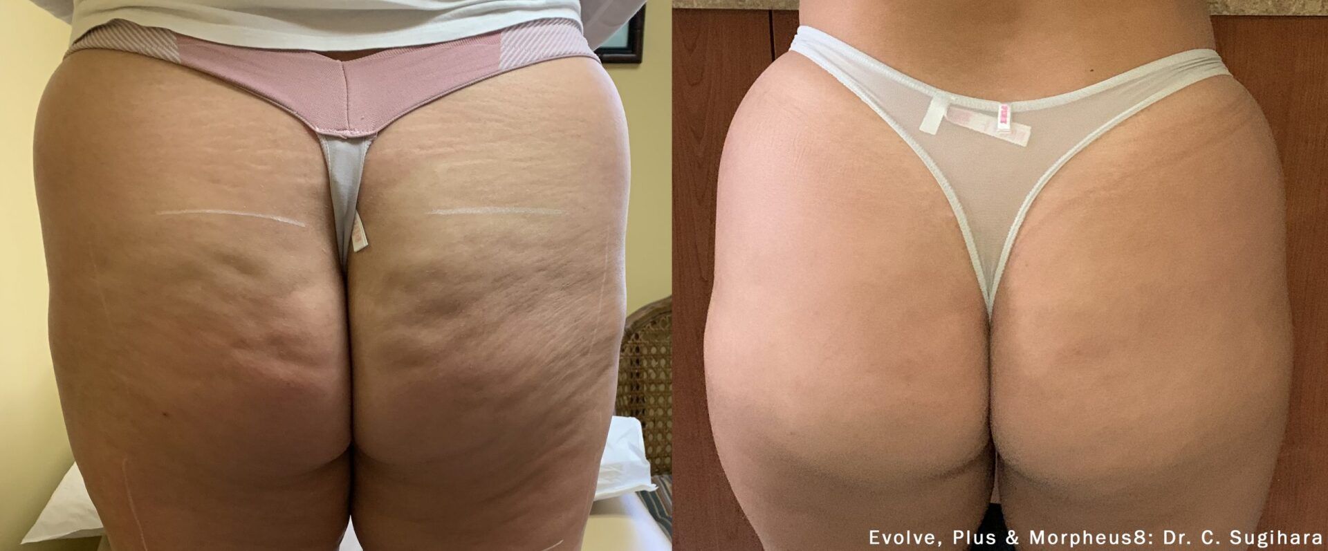 Evolve cellulite treatment: before and after 2