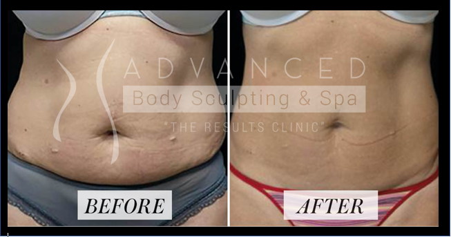 Cryo sculpting: stomach - before and after