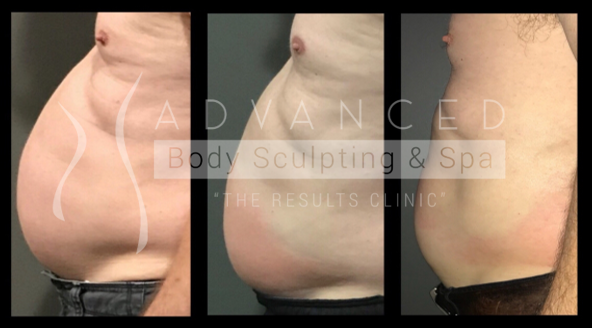 Cryo sculpting: stomach - before and after 2