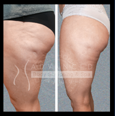 Cellulite treatment: before and after 1