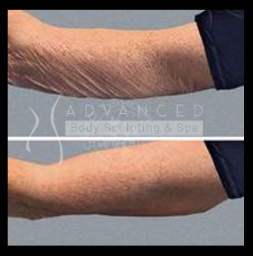 body sculpting: arms - before and after