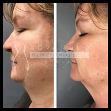 double chin before and after 1