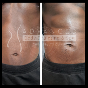 Evolve: stomach - before and after 2