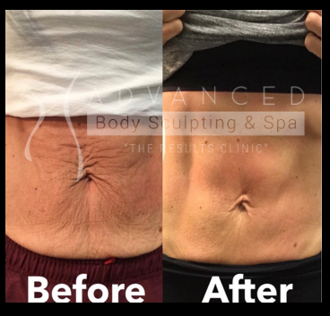 EvolveX: stomach - before and after 3