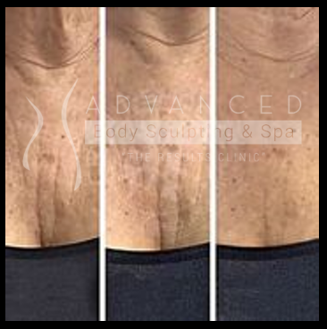 Chest: before and after - skin rejuvenation
